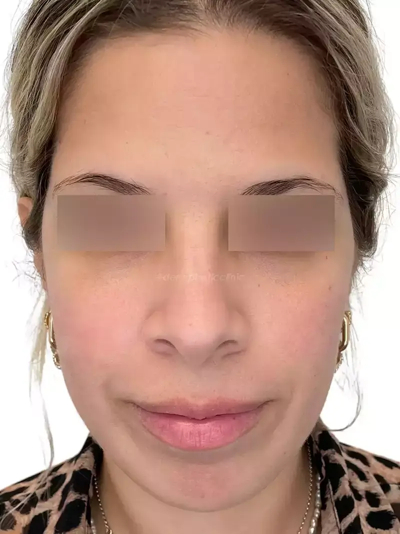 Dermapen Μετά