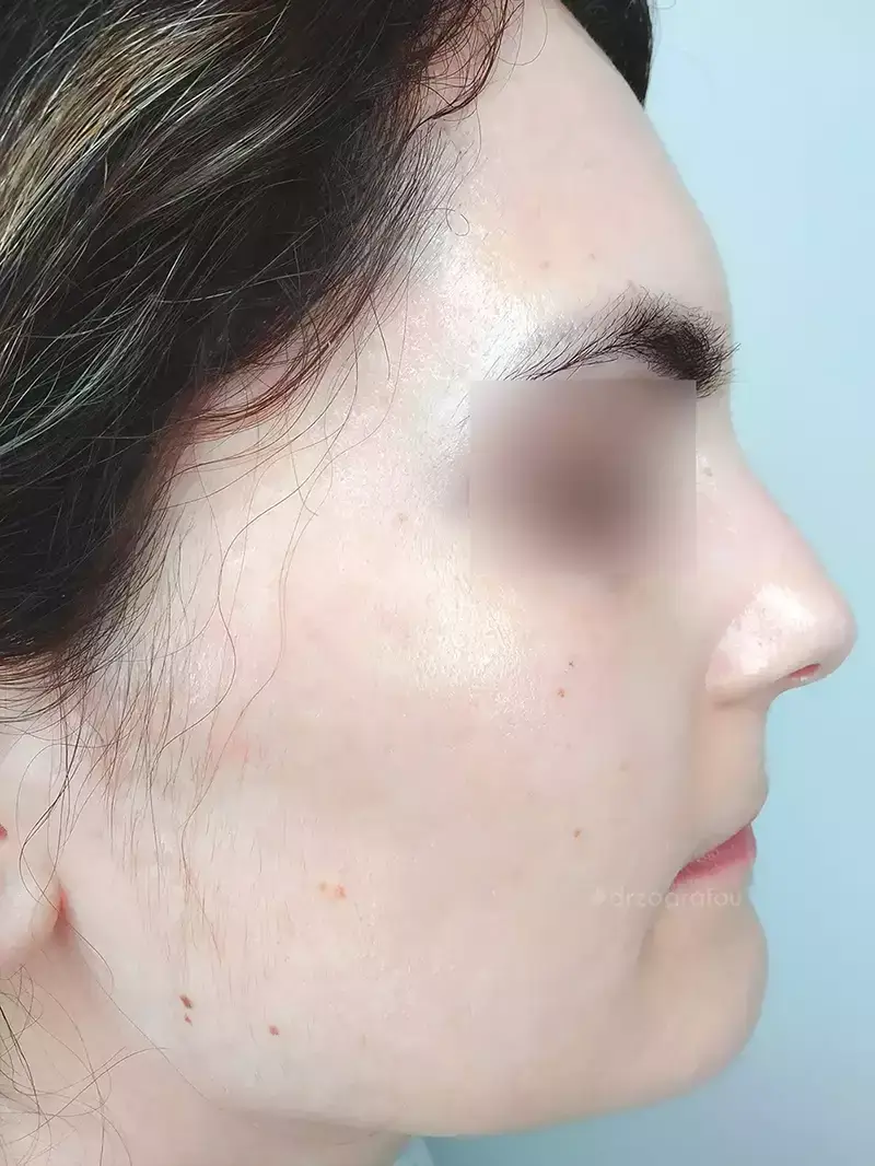 Dermapen Μετά
