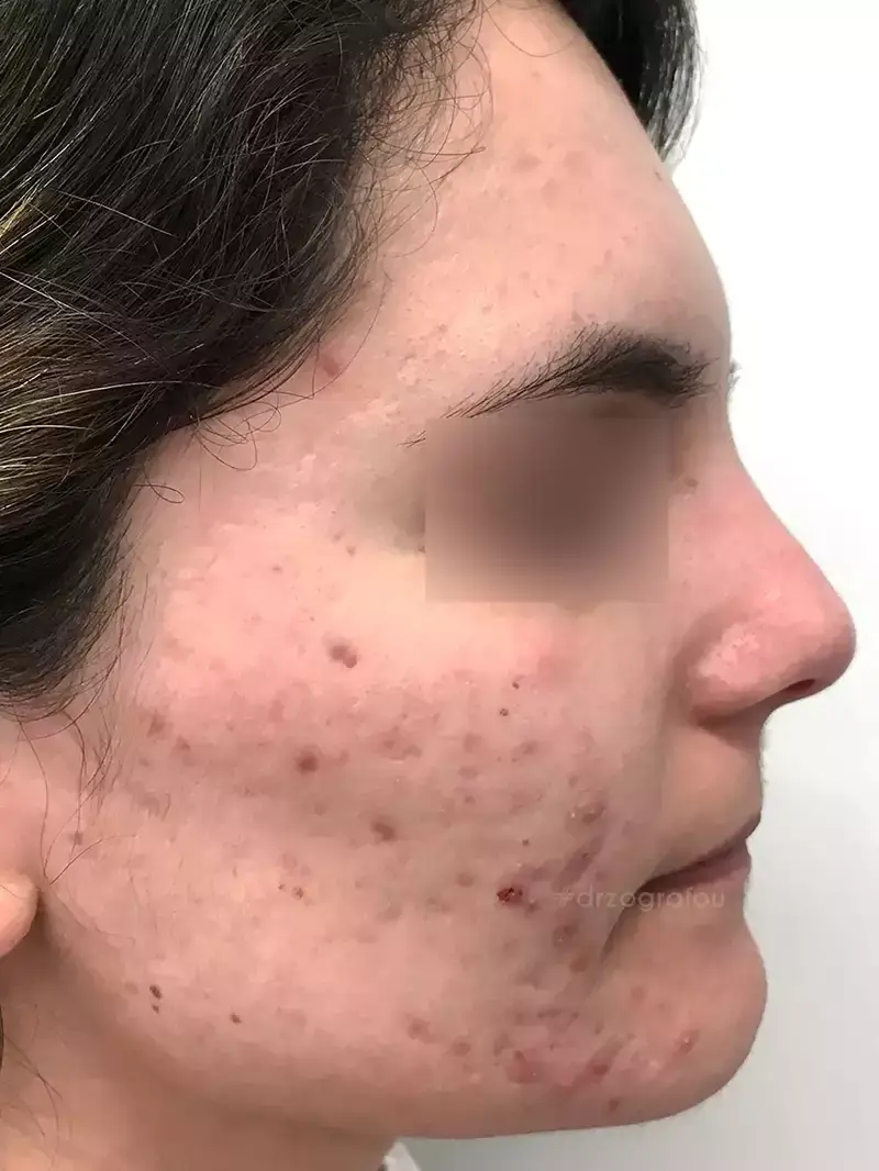 Dermapen Πριν