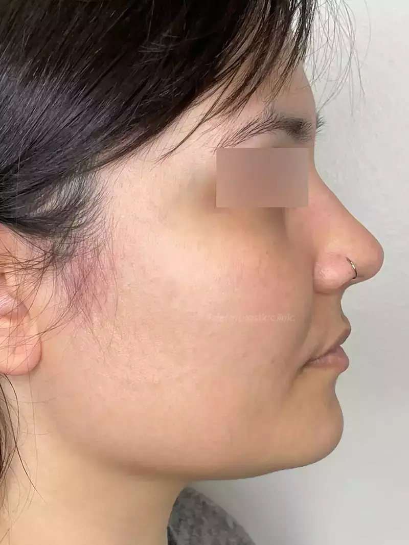 Dermapen Μετά