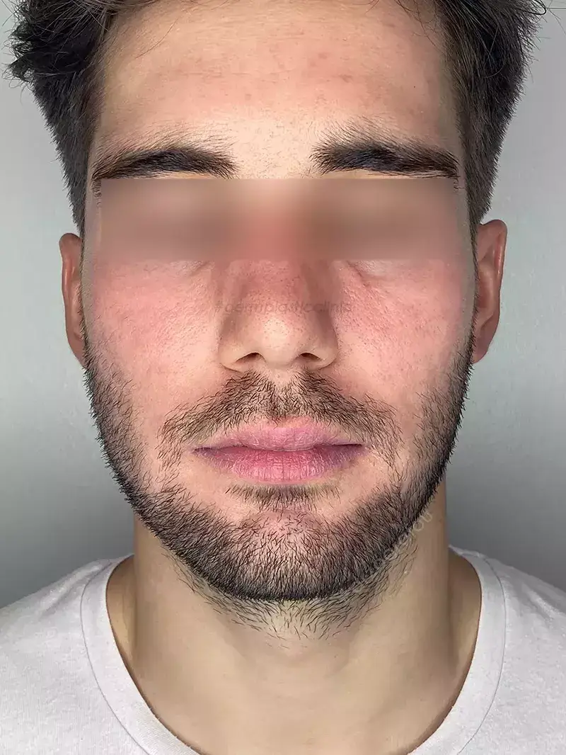 Dermapen Μετά