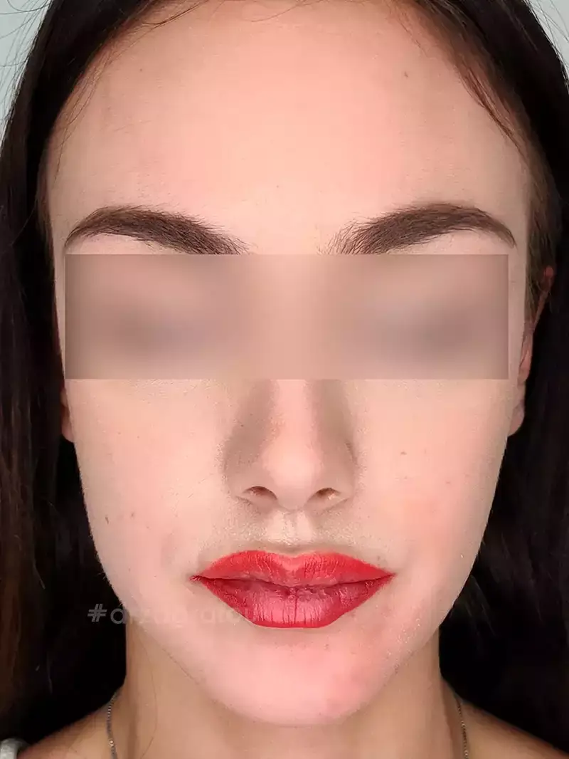 Dermapen Μετά