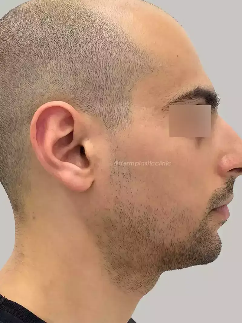 Dermapen Μετά
