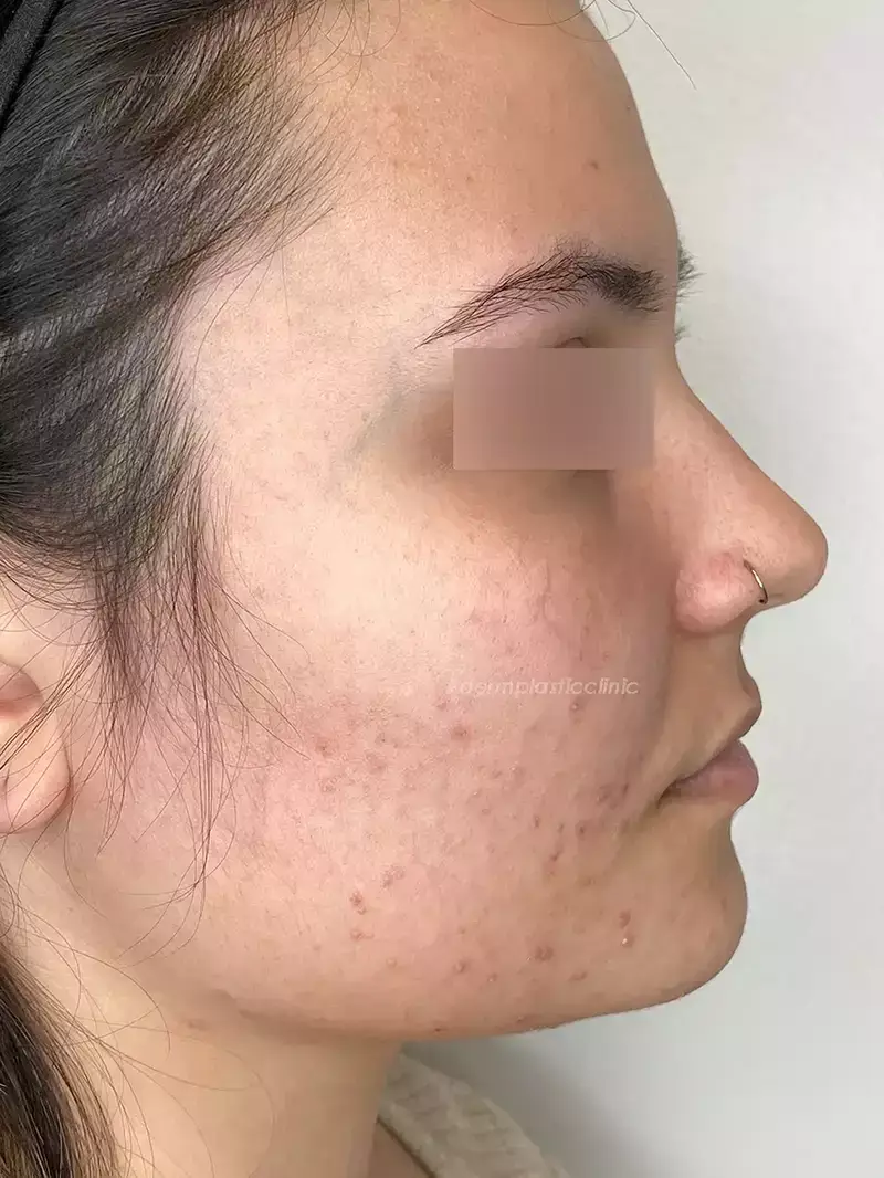 Dermapen Πριν