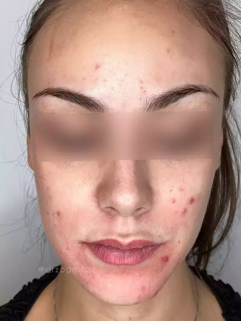 Dermapen Πριν