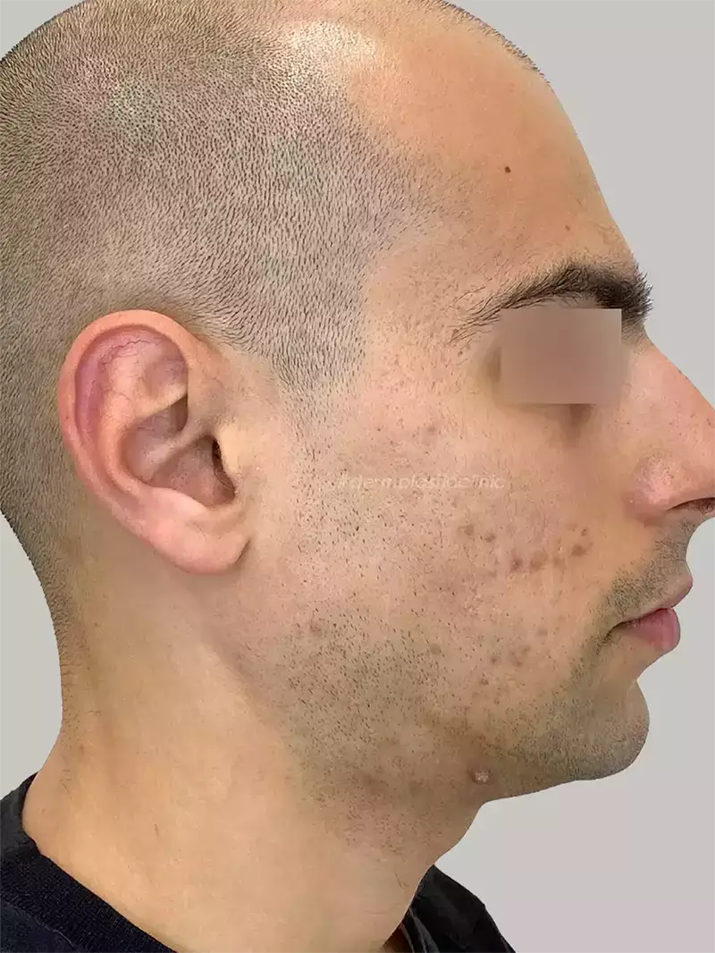 Dermapen Πριν