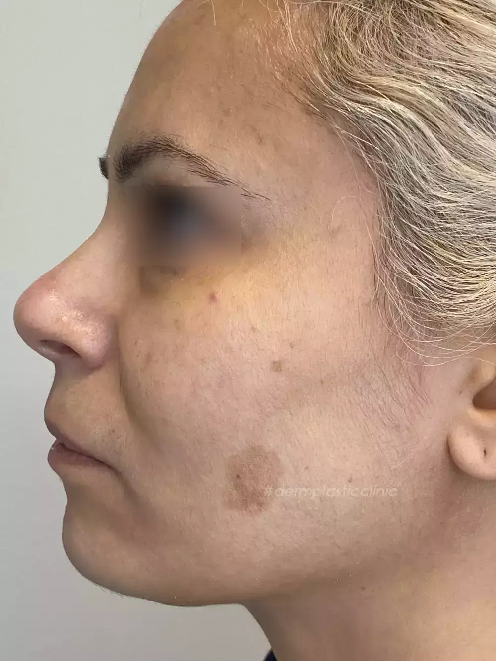 Πανάδες Κηλίδες Πριν