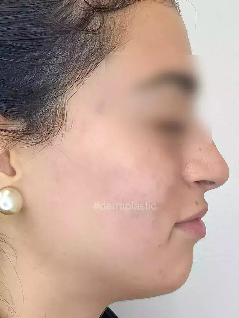 Fractional Laser Προσώπου Μετά