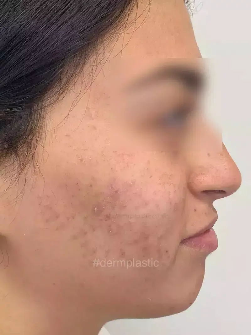 Fractional Laser Προσώπου Πριν