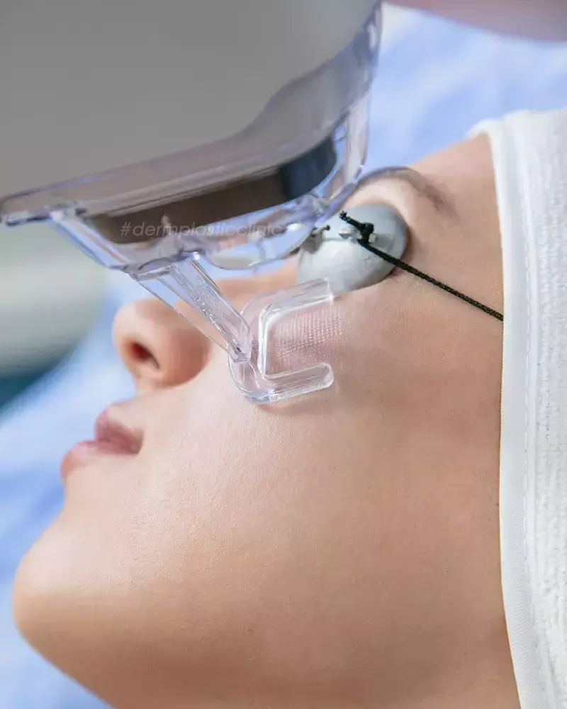 Εφαρμογή Fractional Laser Προσώπου