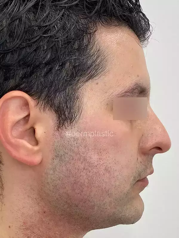 Fractional Laser Προσώπου Μετά
