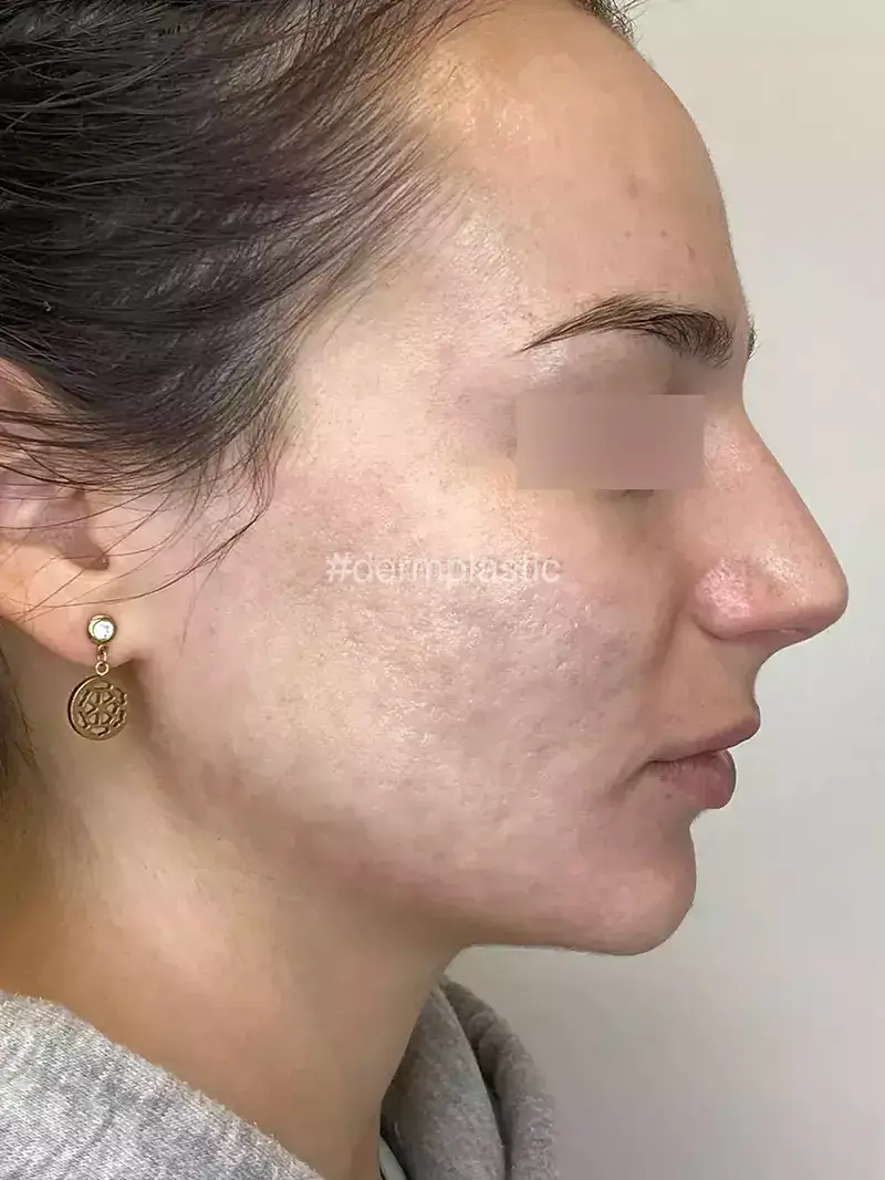 Fractional Laser Προσώπου Μετά