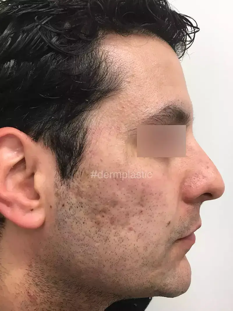 Fractional Laser Προσώπου Πριν