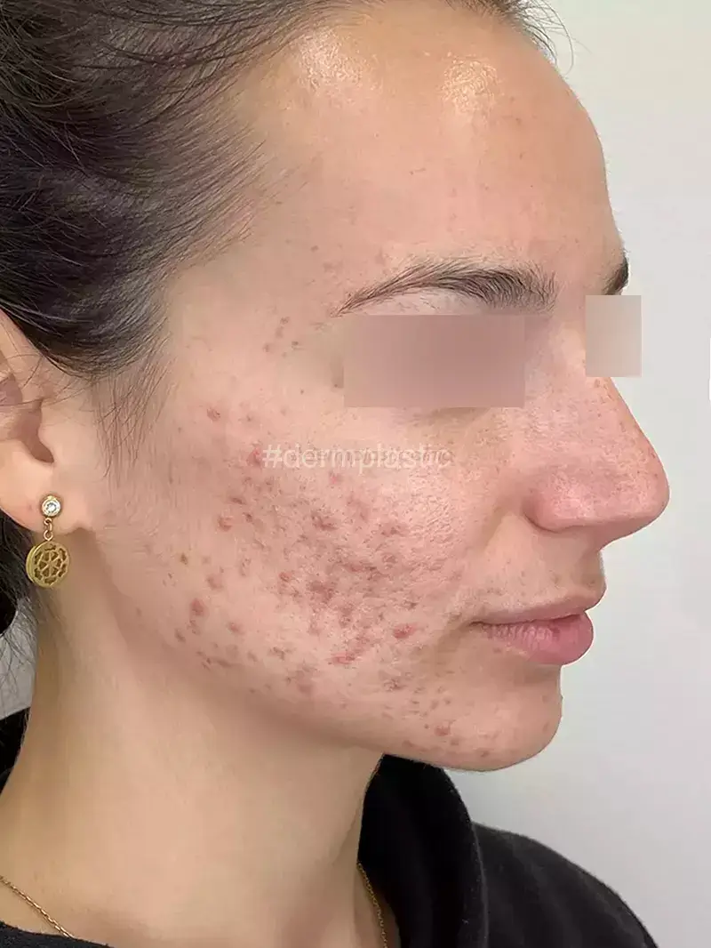 Fractional Laser Προσώπου Πριν