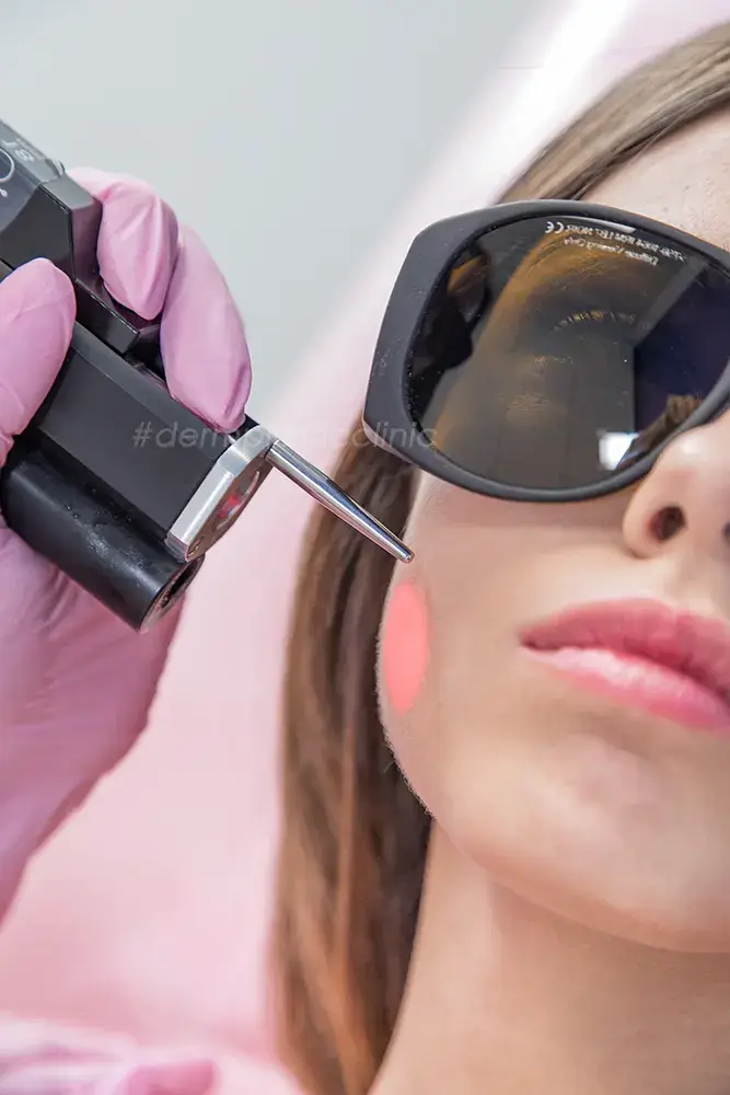 Laser Αποτρίχωση Προσώπου
