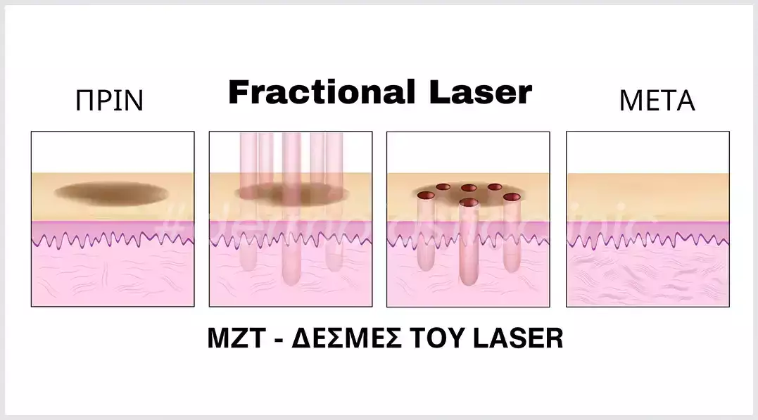 Πως Δρα το Fractional Laser