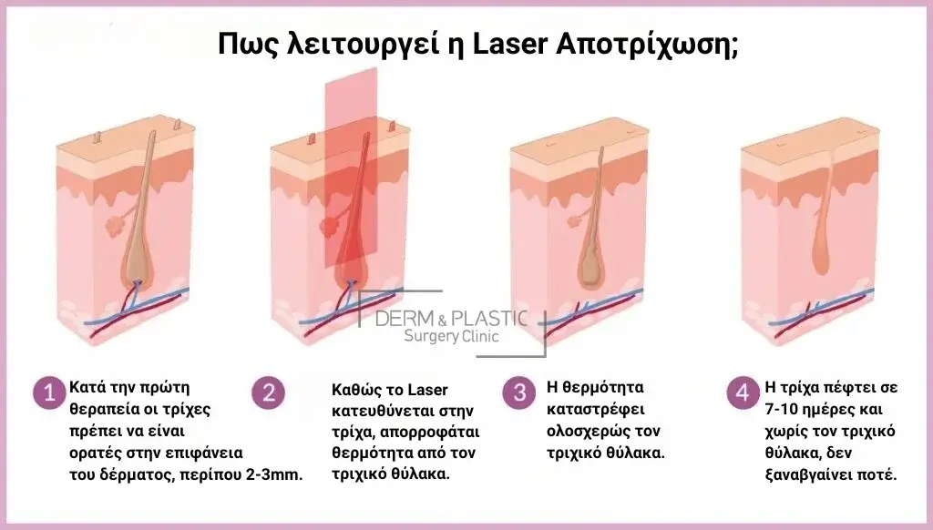 Πως Δρα το Laser Αλεξανδρίτη