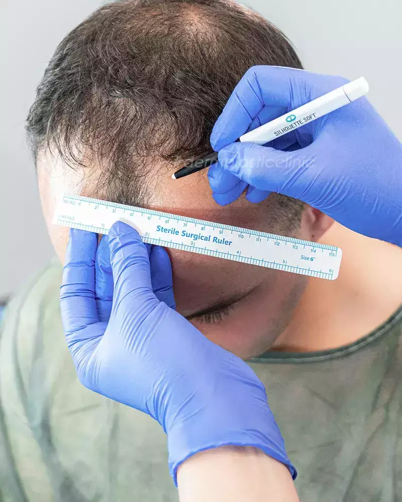 Αποκατάσταση Αρχικού Hairline