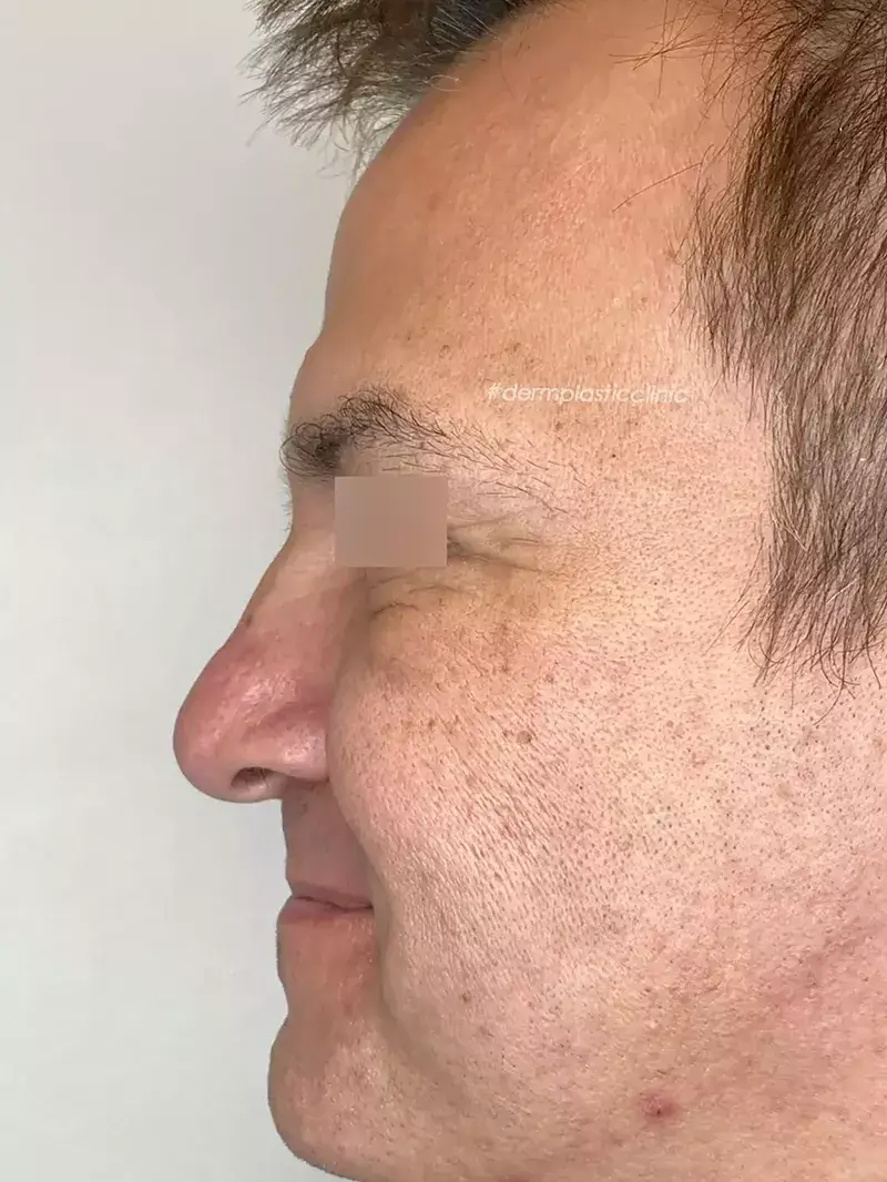 Brotox Φωτογραφία Μετά το Botox Ανδρών στα Μάτια