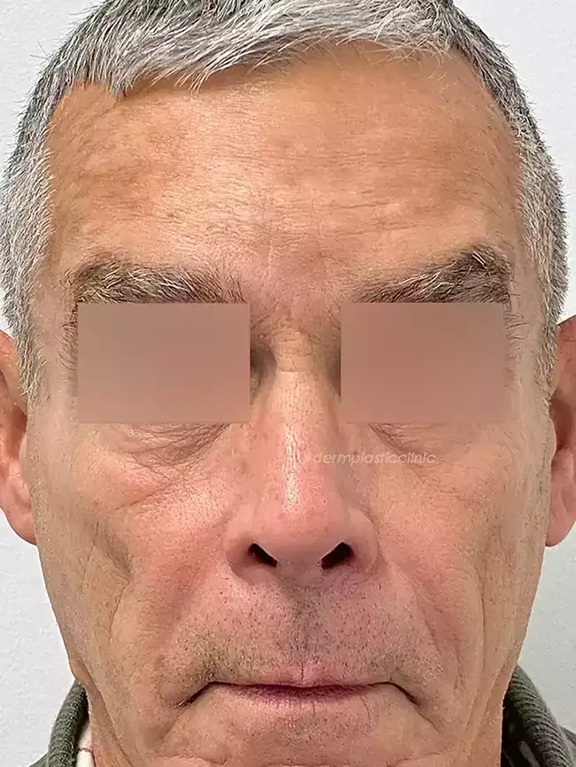 Brotox Φωτογραφία Μετά το Botox Ανδρών στο Μέτωπο