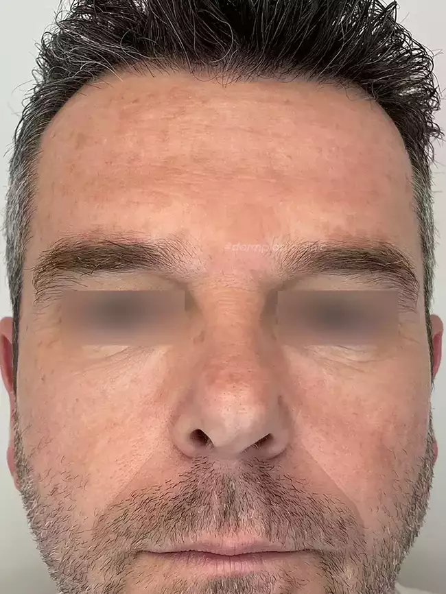Brotox Φωτογραφία Μετά το Botox Ανδρών στο Μεσόφρυο