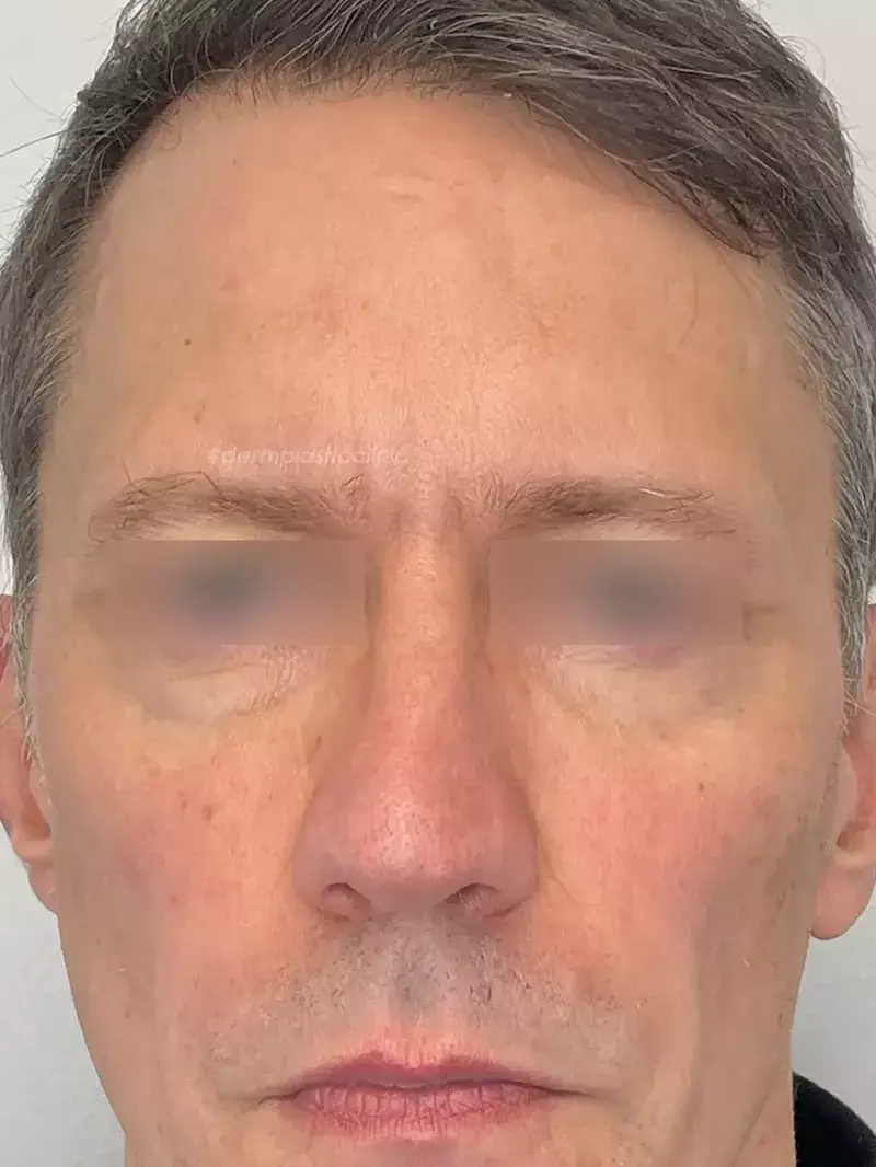 Brotox Φωτογραφία Μετά το Botox Ανδρών στο Μεσόφρυο