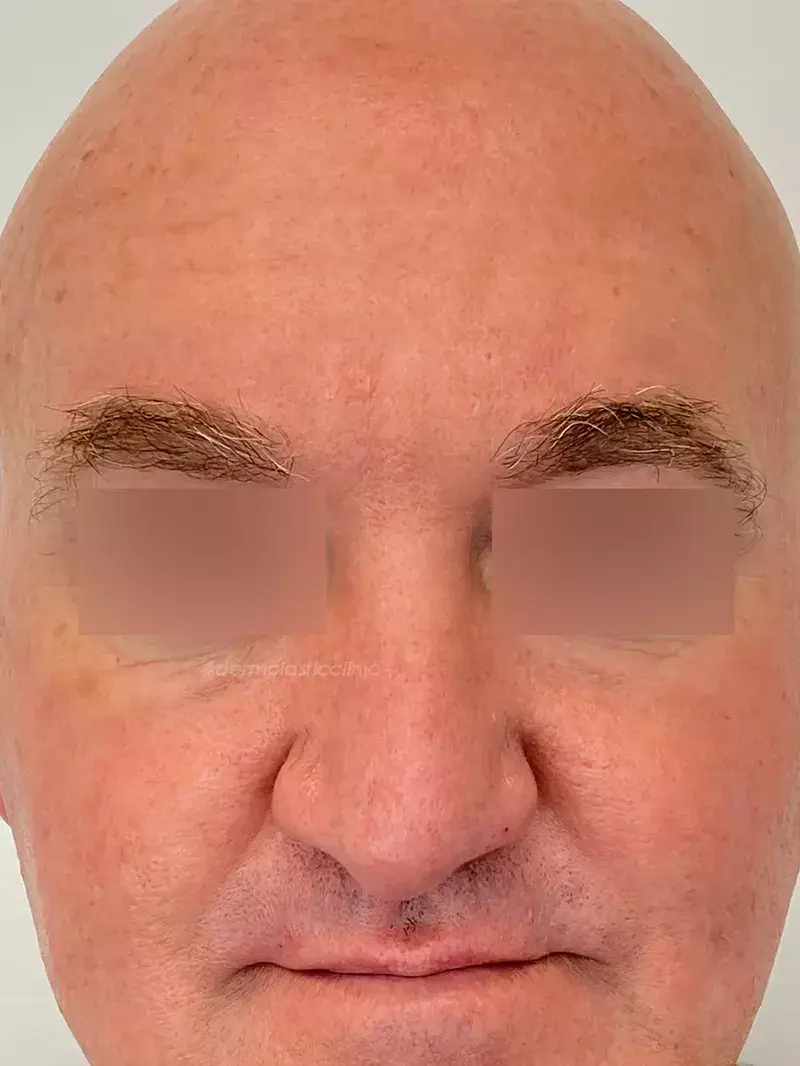 Brotox Φωτογραφία Μετά το Botox Ανδρών στο Μέτωπο
