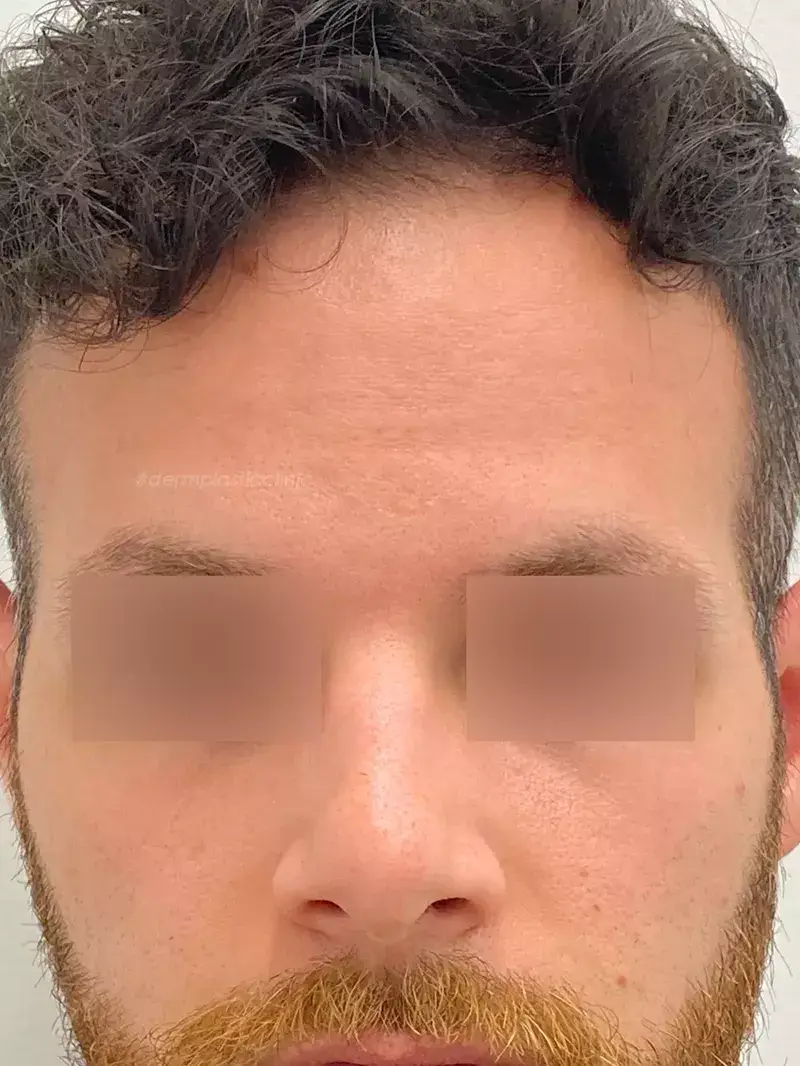 Brotox Φωτογραφία Μετά το Botox Ανδρών στο Μέτωπο