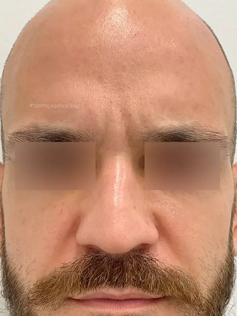 Brotox Φωτογραφία Μετά το Botox Ανδρών στο Μεσόφρυο