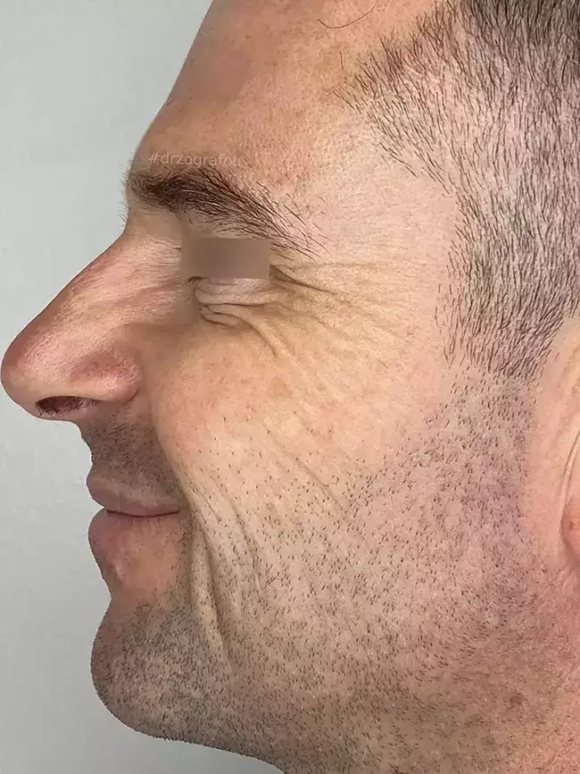Brotox Φωτογραφία Μετά το Botox Ανδρών στα Μάτια