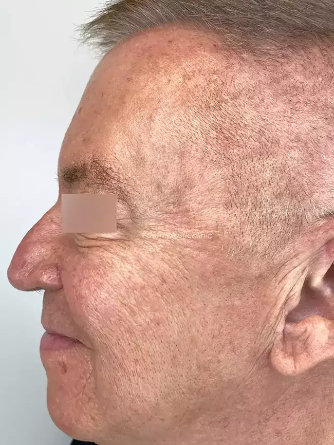 Brotox Φωτογραφία Μετά το Botox Ανδρών στα Μάτια