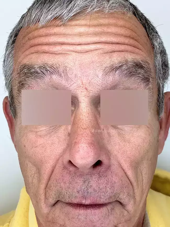 Brotox Φωτογραφία Πριν το Botox Ανδρών στο Μέτωπο