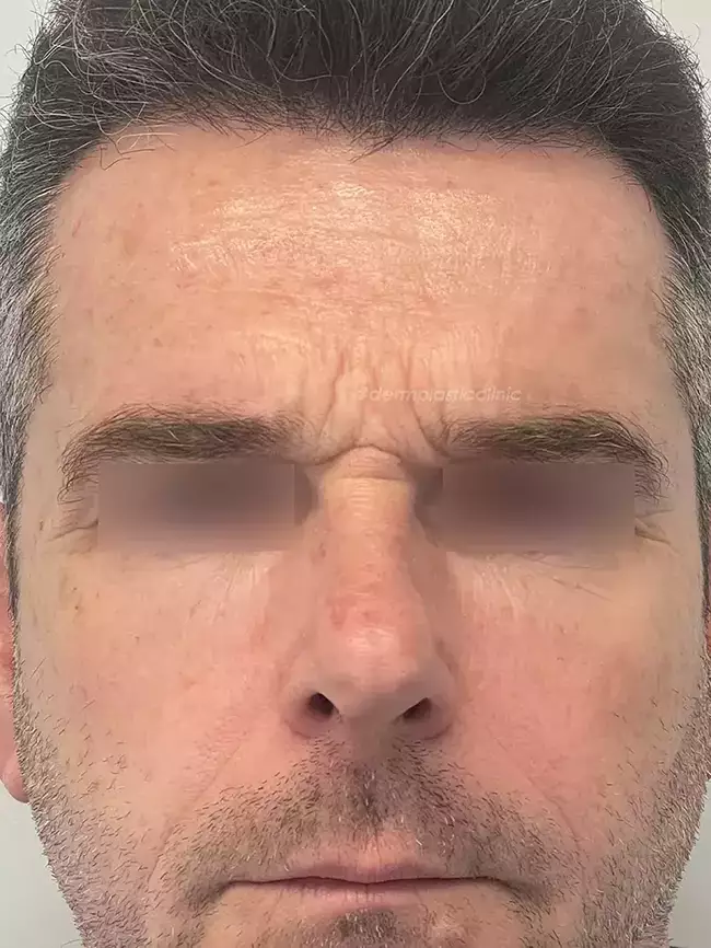 Brotox Φωτογραφία Πριν το Botox Ανδρών στο Μεσόφρυο