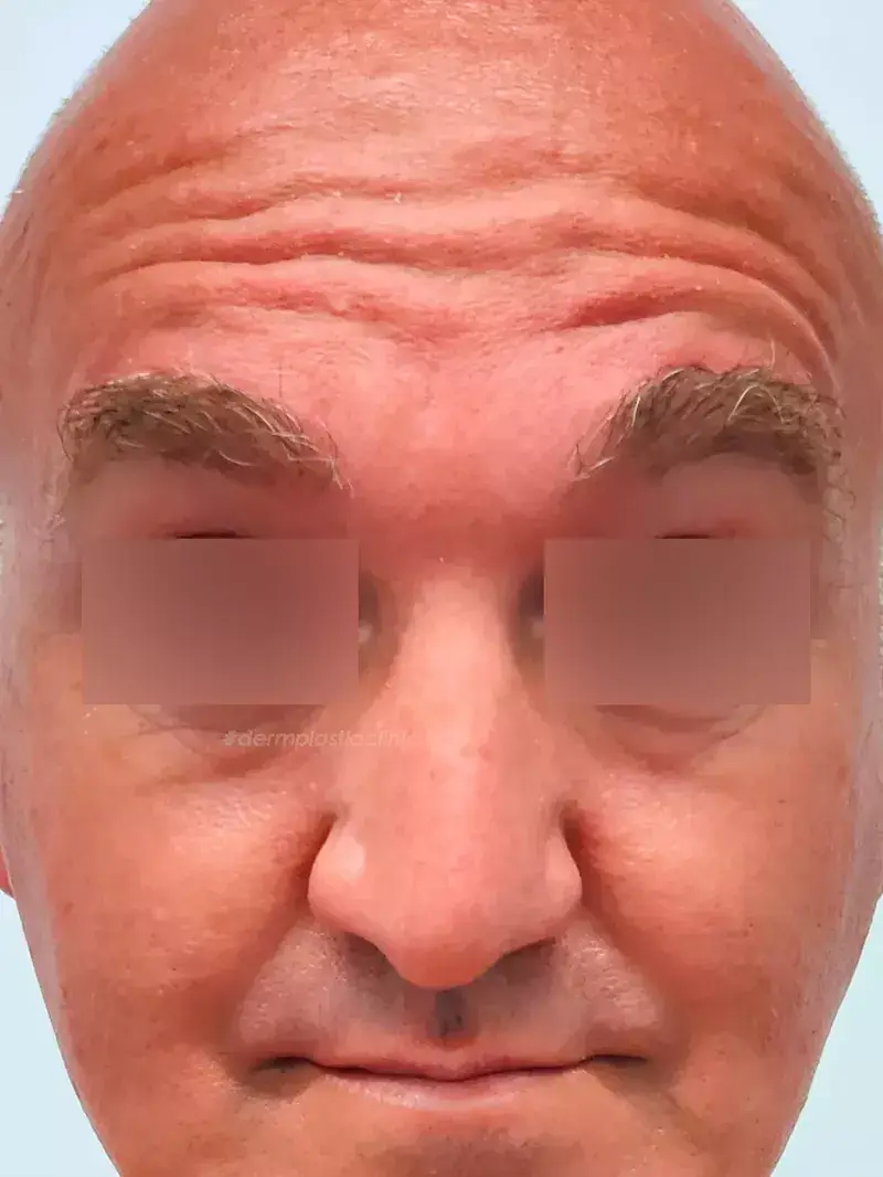 Brotox Φωτογραφία Πριν το Botox Ανδρών στο Μέτωπο