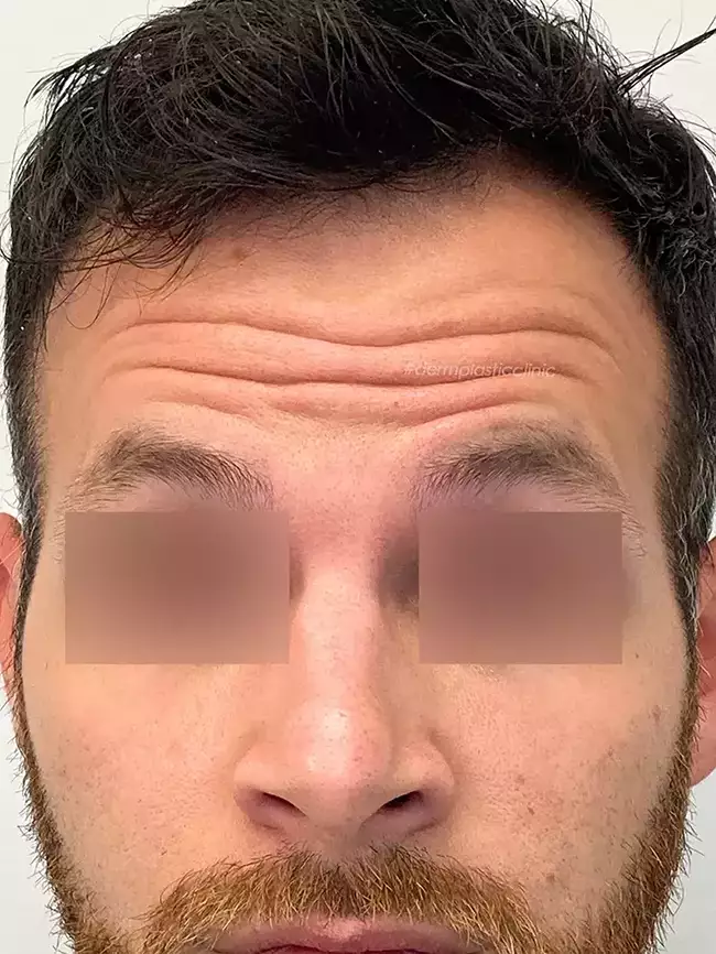 Brotox Φωτογραφία Πριν το Botox Ανδρών στο Μέτωπο
