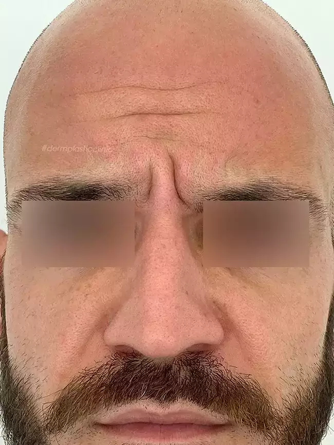 Brotox Φωτογραφία Πριν το Botox Ανδρών στο Μεσόφρυο