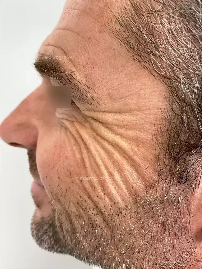 Brotox Φωτογραφία Πριν το Botox Ανδρών στα Μάτια