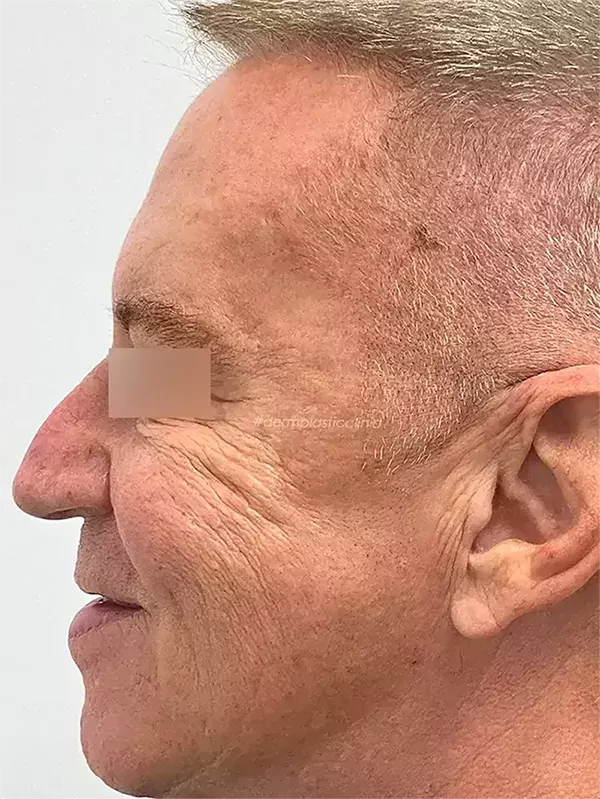 Brotox Φωτογραφία Πριν το Botox Ανδρών στα Μάτια