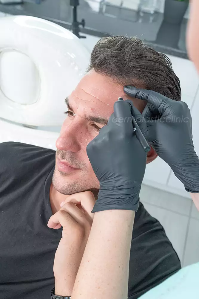 Brotox Σημεία Έγχυσης