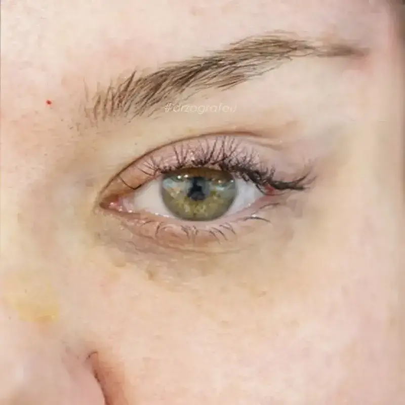 Cat Eyes Lift Φωτογραφία Μετά