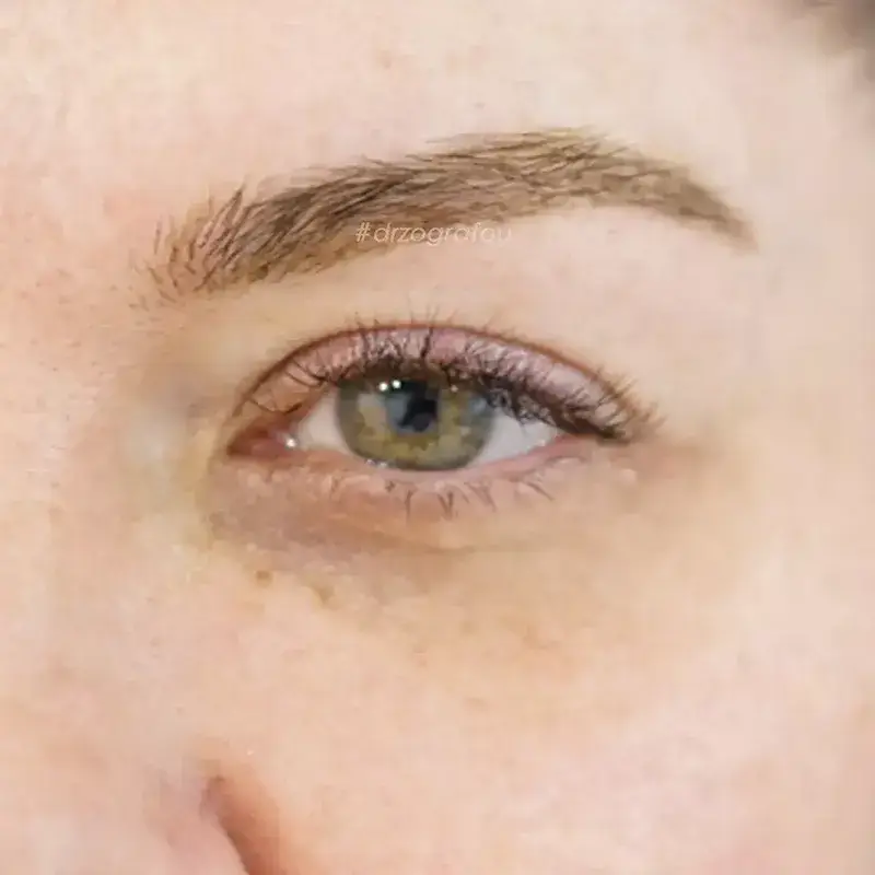 Cat Eyes Lift Φωτογραφία Πριν