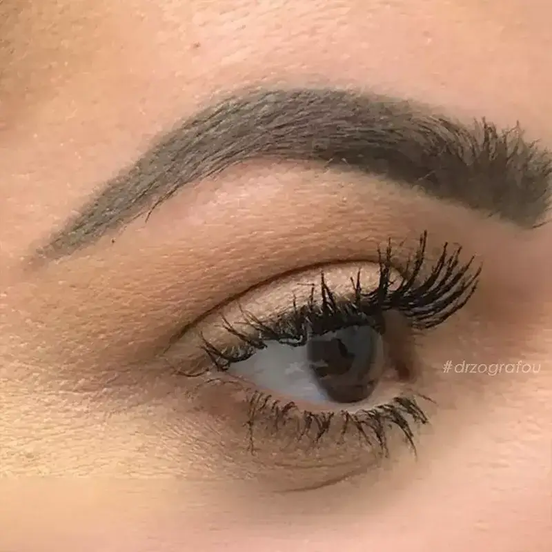 Cat Eyes Lift Φωτογραφία Πριν