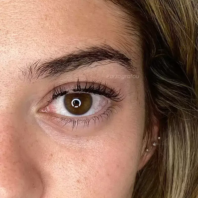 Cat Eyes Lift Φωτογραφία Μετά
