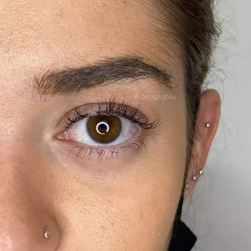 Cat Eyes Lift Φωτογραφία Πριν