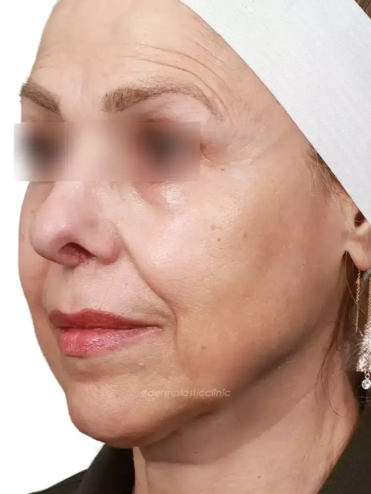 Ραδιοσυχνότητες Προσώπου Φωτογραφία Πριν