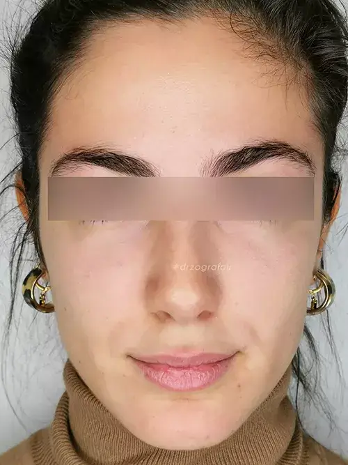 Nanosoft Φωτογραφία Μετά τη Θεραπεία για Μαύρους Κύκλους