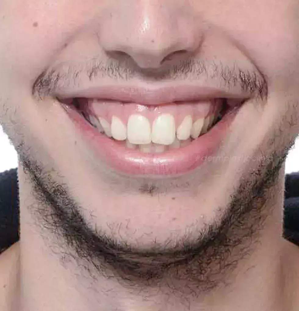 Ουλικό Χαμόγελο Gummy Smile Botox