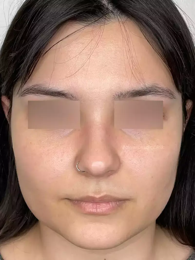Χημικό Peeling Φωτογραφία Μετά