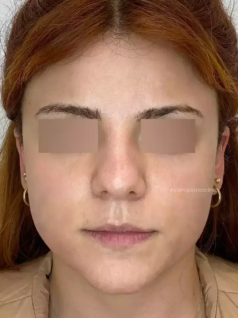 Χημικό Peeling Φωτογραφία Μετά