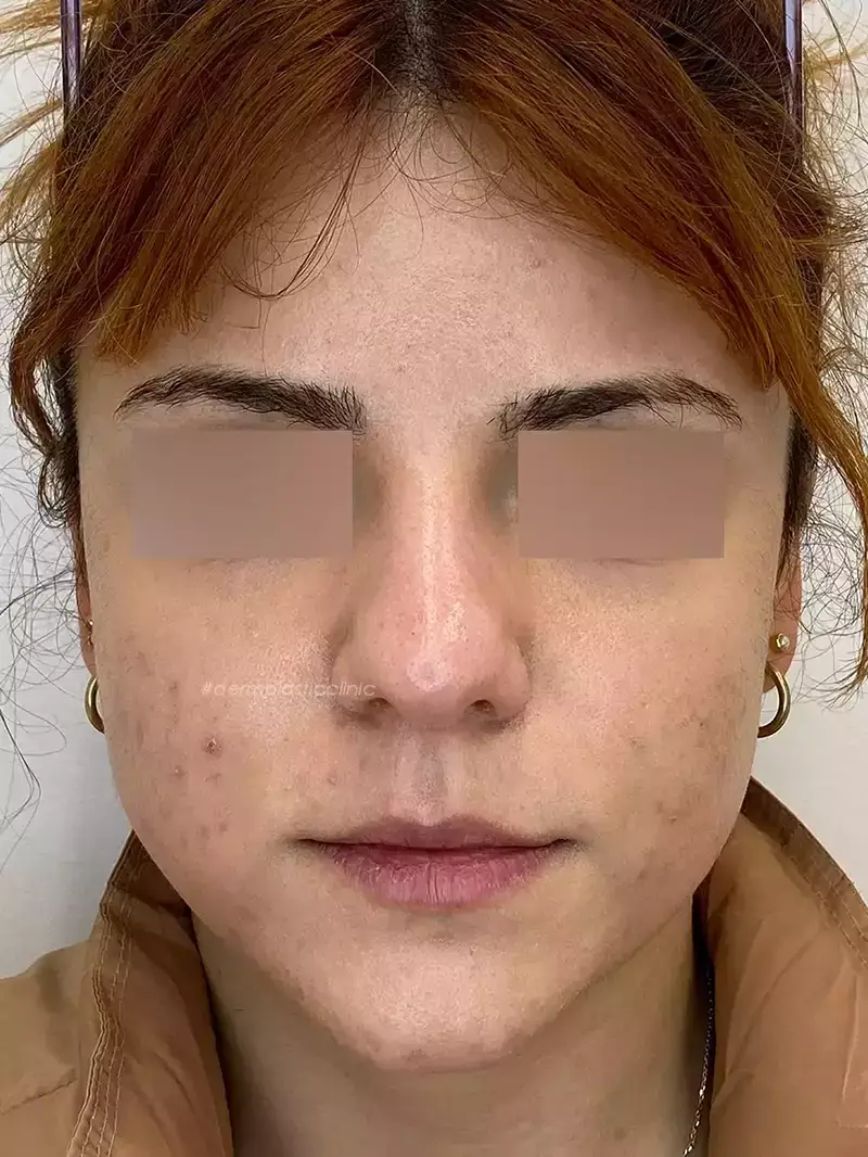 Χημικό Peeling Φωτογραφία Πριν